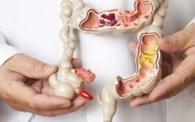 L’alimentation au secours de l’intestin irritable
