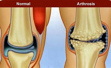 lille dunkerque formation naturopathe ecole synergie naturopathie arthrose osteomusculaire